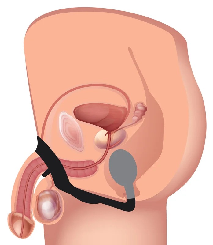 10XP-BombSiliconeCockandBallRingwithVibratingAnalPlug